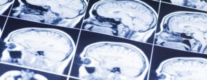 Head and brain injury